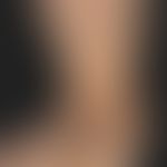 Papillomatosis cutis lymphostatica. Ausgangsbefund mit flächig-keratotischen Auflagerungen.
