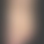 Papillomatosis cutis lymphostatica. Exzessiver Befund mit flächigen baumrindenartigen Borkenaufla...