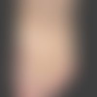 Papillomatosis cutis lymphostatica: Excessive findings with bark deposits on the lower legs and t...