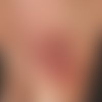 Parapsoriasis en plaques, large-hearthy inflammatory form. increasing palpability of the plaques,...