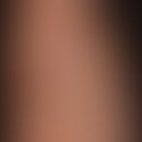 parapsoriasis en petites plaques. disseminated in the skin tension lines of the skin aligned, elo...