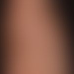 parapsoriasis en petites plaques. disseminated in the skin tension lines of the skin aligned, elo...