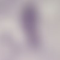 Loiasis. microfilariae of Loa loa in the blood. the microfilariae have a sheath, the nuclei reach...