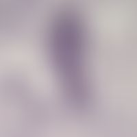 loiasis. microfilariae of loa loa in the blood. the body consists of three core rows. the microfi...