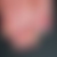 Paronychia candidamycetica. Seit Jahren bestehende chronische Paronychie mit schwerer (Candida-)O...