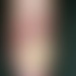 Paronychia candidamycetica. Seit Jahren bestehende, chronische Paronychie mit schwerer Candida-On...