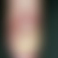 Paronychia candidamycetica. Seit Jahren bestehende, chronische Paronychie mit schwerer Candida-On...