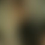 Pediculosis capitis: Numerous nits, recognizable as white spots on the hair shaft, in a 7-year-ol...