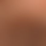 Pediculosis capitis:Numerous nits, recognizable as multiple, pearl-like, white nodules on the hai...