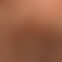 Pediculosis capitis:Numerous nits, recognizable as multiple, pearl-like, white nodules on the hai...