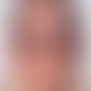 Pellagroid. Chronisch dynamische (nach UV-Exposition Juckreiz und Brennen), nur in belichteten Ar...