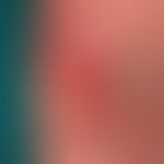 Pemphigoid, bullöses:&nbsp;großflächige, girlandenförmig begrenzte, urtikarielle Erytheme sowie g...
