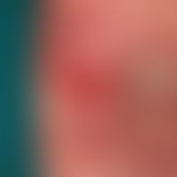 Pemphigoid, bullöses:&nbsp;großflächige, girlandenförmig begrenzte, urtikarielle Erytheme sowie g...