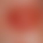 Pemphigoid, bullöses:&nbsp;große, prall gespannte (subepithelial lokalisierte) Blase mit rötliche...