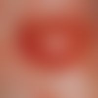 Pemphigoid, bullous. Large, bulging, tense (subepithelial localized) bladder.
