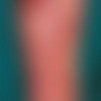 Pemphigoid, bullous. Large, stable blisters on flat, urticarial erythema in the area of the lower...