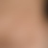 Pemphigoid, bullous. general view: state of healing. Disseminated, sharply defined or confluent, ...