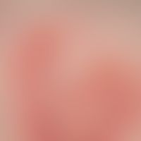 Pemphigoid, bullous. detail: 1-6 mm large, tightly stretched blisters filled with clear secretion...