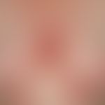 Pemphigoid, bullöses. Übersichtsaufnahme: Maximal exazerbiertes Krankheitsbild an Stamm und Extre...