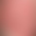 Pemphigoid, bullöses&nbsp;(Detailvergrößerung): multiple, ursprünglich straffe Blasen, die sich w...