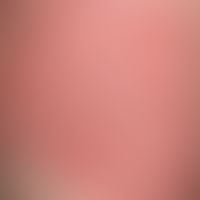Pemphigoid, bullous. detail enlargement: multiple, originally tight blisters, which have largely ...