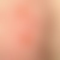 Pemphigoid, bullous. bulging, 0.4-1.2 cm large blisters on the buttocks of a 44-year-old man. In ...