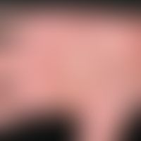 Pemphigoid, bullous. 1 year old, itchy blisters on the left hand of an 82-year-old woman, filled ...