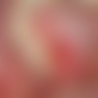 Pemphigoid, bullous. detail enlargement: Chronically active, intermittent, enoral, laminar erosio...