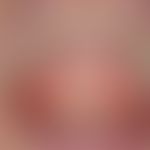 Pemphigoid, bullöses (Detailaufnahme): Chronisch aktive, schubweise auftretende, enorale, beidsei...