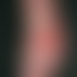 Pemphigoid, bullöses. Multiple, z.T. mehrere cm durchmessende, schlaffe, z.T. aufgeplatzte Blasen...