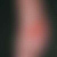 Pemphigoid, bullous, multiple, sometimes several centimeters in diameter, flaccid, sometimes burs...