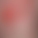 Pemphigoid, bullöses (Detailvergrößerung): Multiple, z.T. mehrere cm durchmessende, schlaffe Blas...