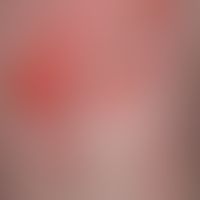 Pemphigoid, bullous. detail enlargement: Multiple, sometimes several cm wide, flaccid blisters wi...