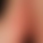 Pemphigoid, bullöses:&nbsp;vor 5 Wochen entstandene, akute, an der Innenseite des rechten Oberarm...