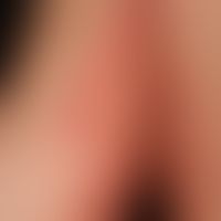 Pemphigoid, bullous. 5 weeks ago, acute, on the inner side of the right upper arm localized, diss...