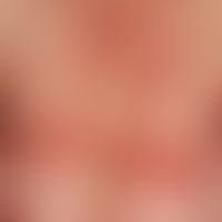 pemphigoid, bullous

