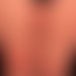 Pemphigoid bullöses: Krankheitsbild das v.a. durch seinen exzessiven Juckreiz imponierte. Hautver...