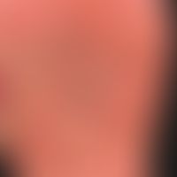 Pemphigoid, bullous
