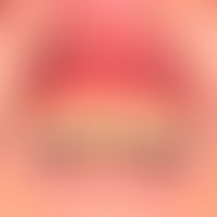 Schleimhautemphigoid: flächenhafte,&nbsp;schmerzhafte Erosion der&nbsp; Gingiva. Begleitende chro...