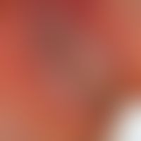 Pemphigus chronicus benignus familiaris. Schmierig belegte, scharf begrenzte, raue Plaque im Bere...