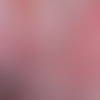 Pemphigus chronicus benignus familiaris: Diagnostically path-breaking, lineal and punctiform eros...