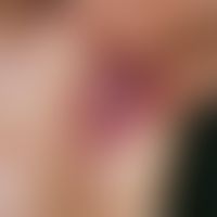 pemphigus chronicus benignus familiaris. multiple, chronically dynamic (very changeable course wi...