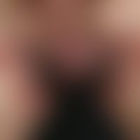 Pemphigus chronicus benignus familiaris: Multiple, chronically dynamic (changing course), greasy,...