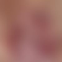 Pemphigus chronicus benignus familiaris. Chronisch dynamische (wechselnder Verlauf), schmierig be...