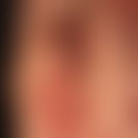 Pemphigus chronicus benignus familiaris: chronic, extremely therapy-resistant, varying in size, s...