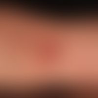 Pemphigus chronicus benignus familiaris: Relatively uncharacteristic "eczematous" plaque in the c...
