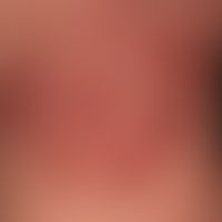Pemphigus chronicus benignus familiaris: Migrating circulatory plaques with peripheral scaling an...