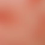 Pemphigus erythematosus. Nahaufnahme: gerötete Papeln und Plaques mit krustigen Schuppenauflageru...