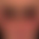 Pemphigus erythematosus: clinical picture similar to chronic discoid lupus erythematosus with sha...