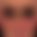 Pemphigus erythematosus: dem chronisch diskoiden Lupus erythematodes ähnelndes Krankheitsbild mit...